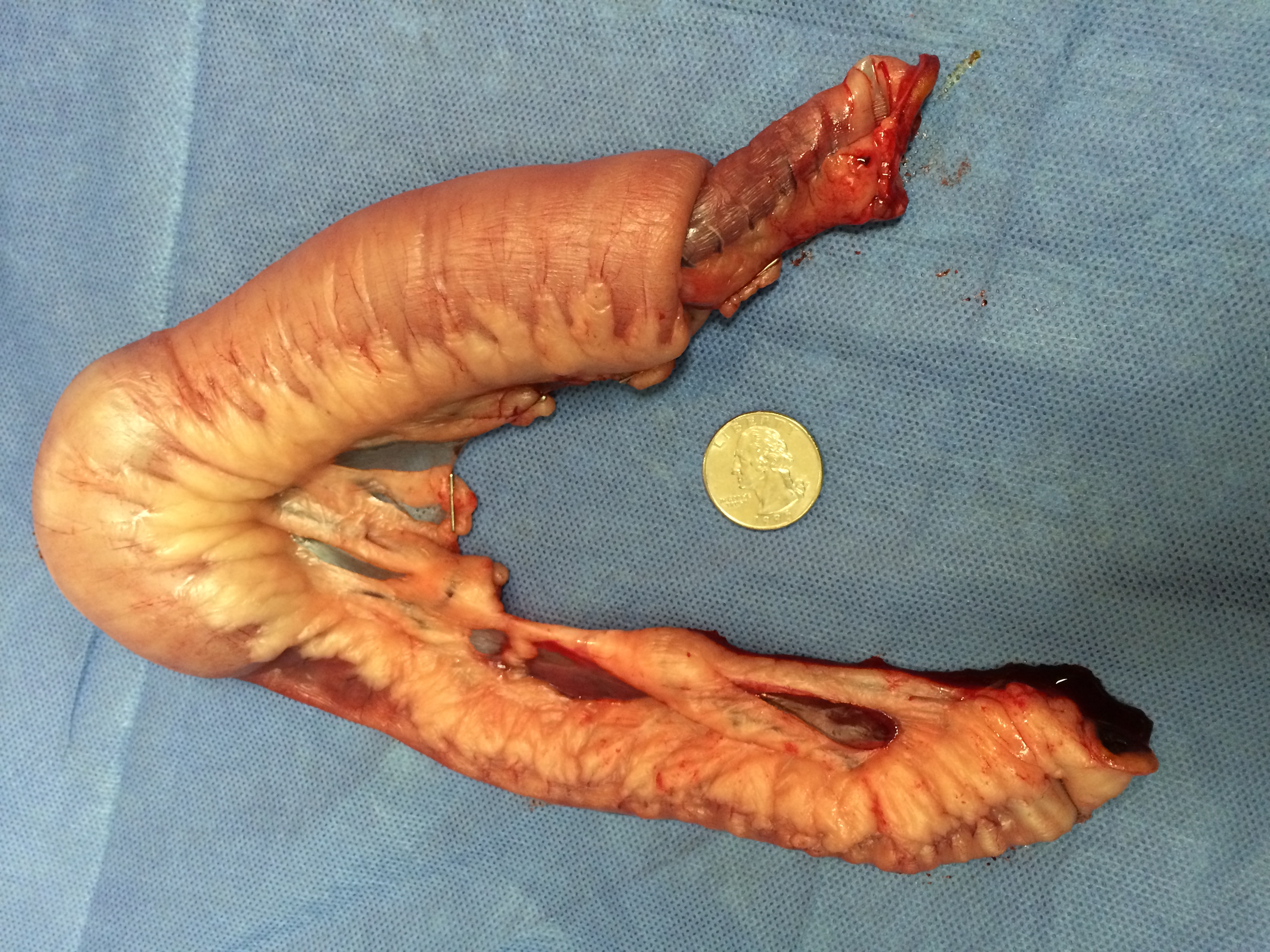 intussusception Archives | Dr Phil Zeltzman’s Blog3264 x 2448