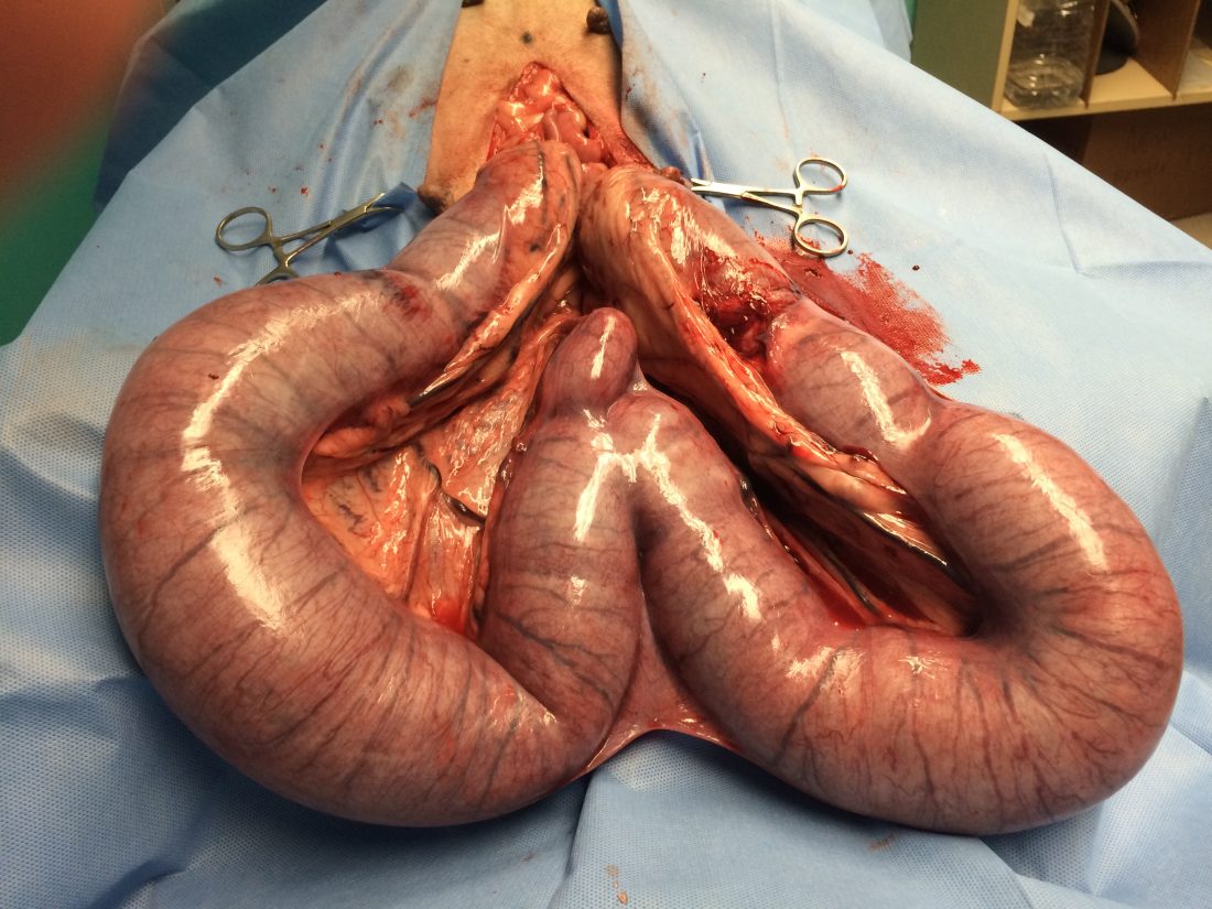 Dakota's uterus during surgery