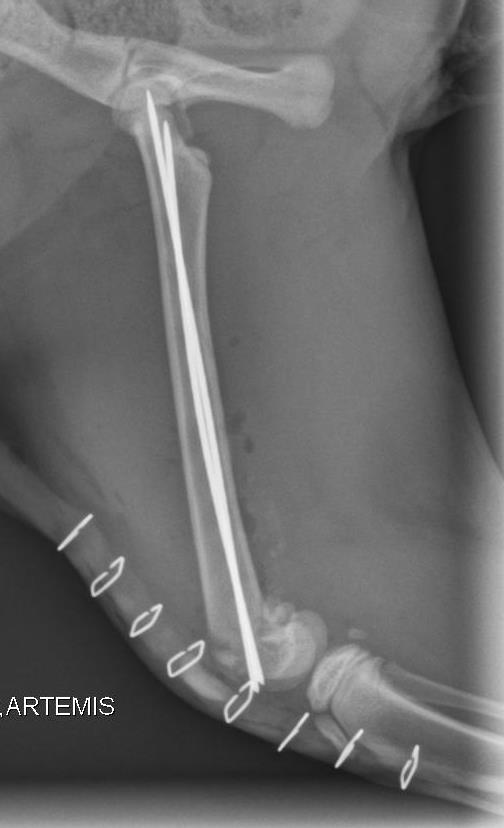 Post-op with pins in the bone