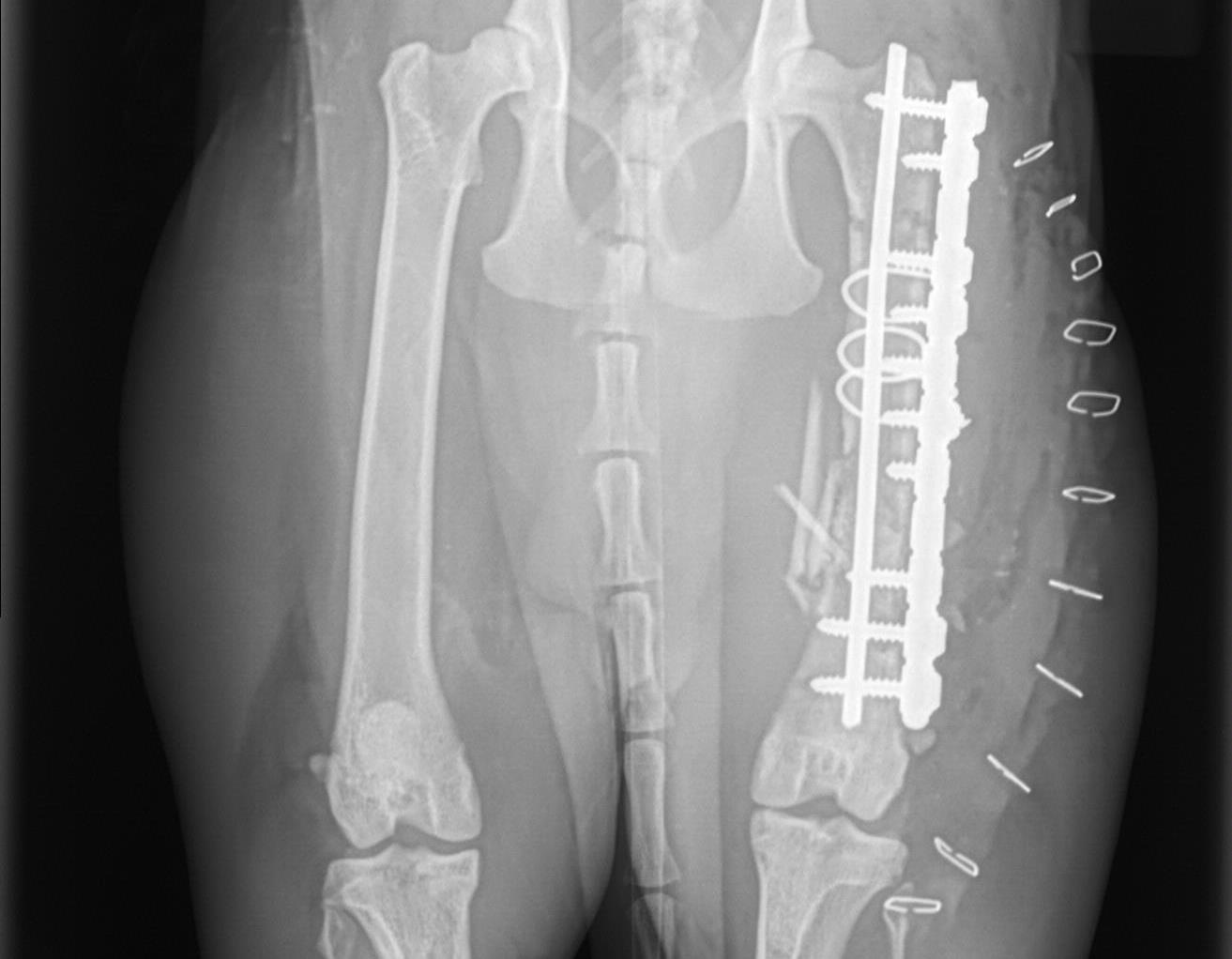 The bone is stabilized with pins and screws