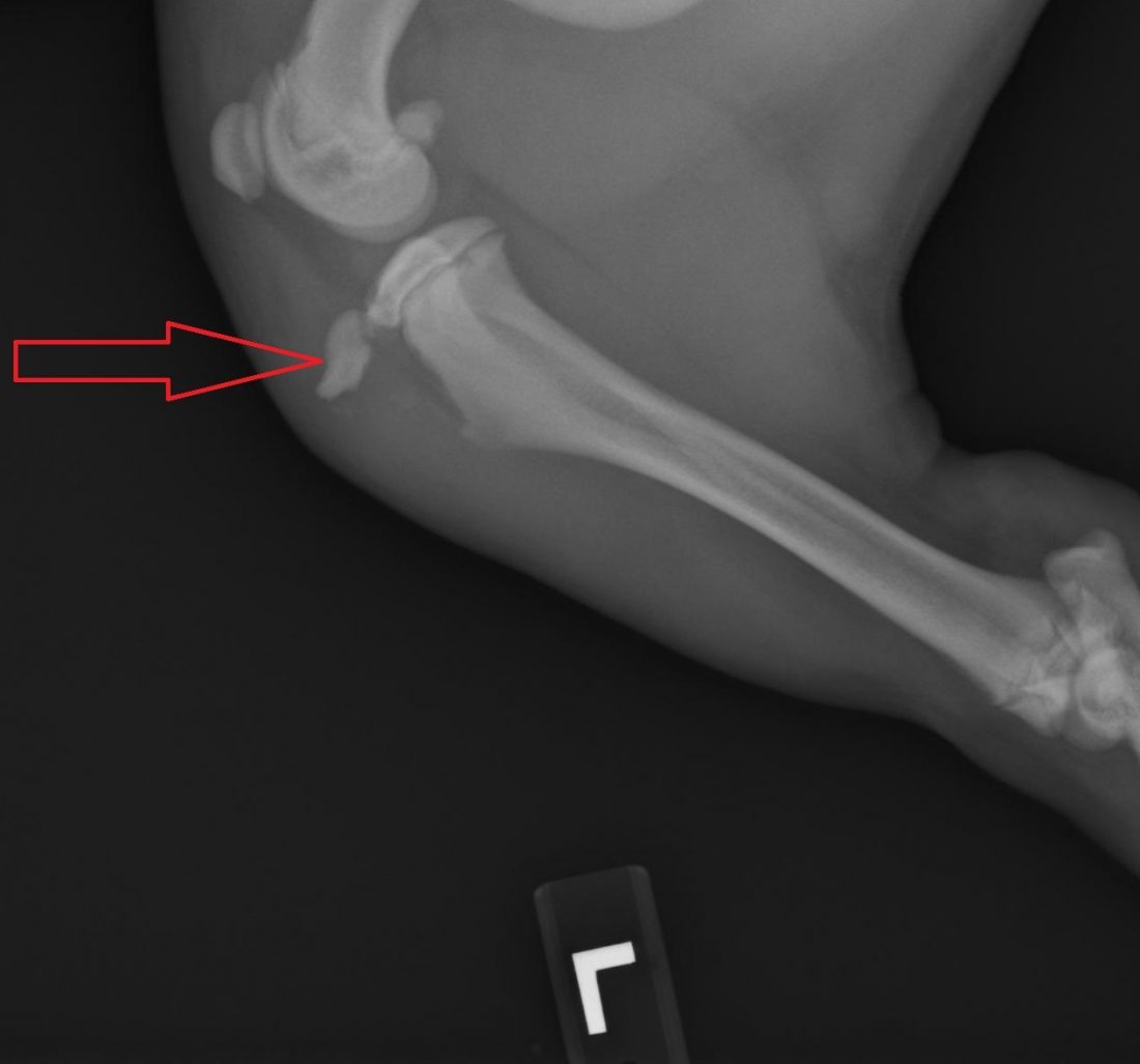 tibial crest avulsion Archives | Dr Phil Zeltzman’s Blog