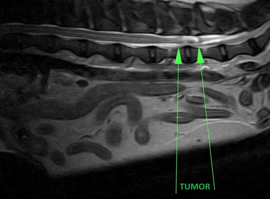 A tumor on the spine