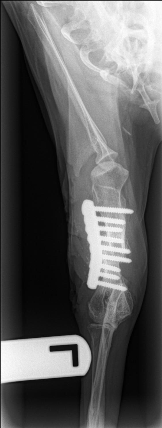 A metal plate and 9 screws holding the bone together