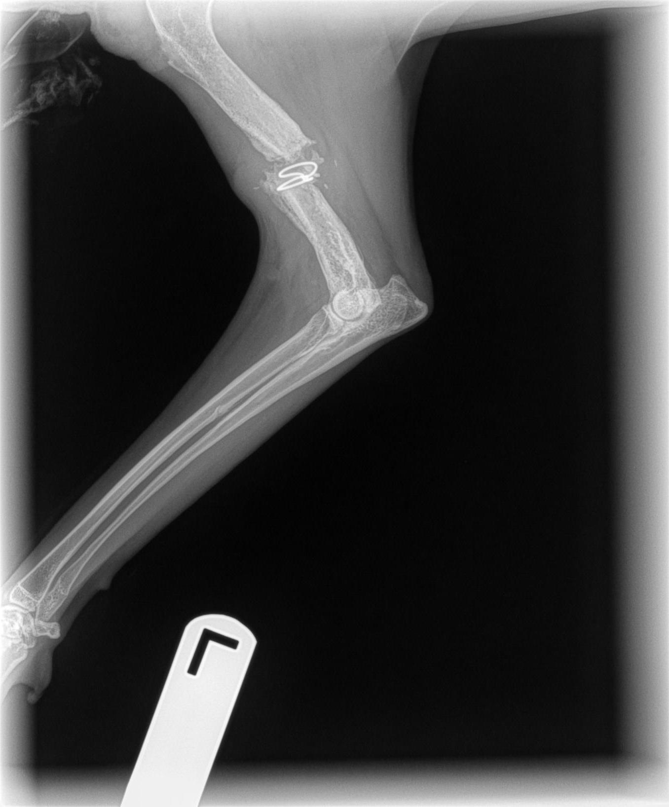 A fractured left humerus