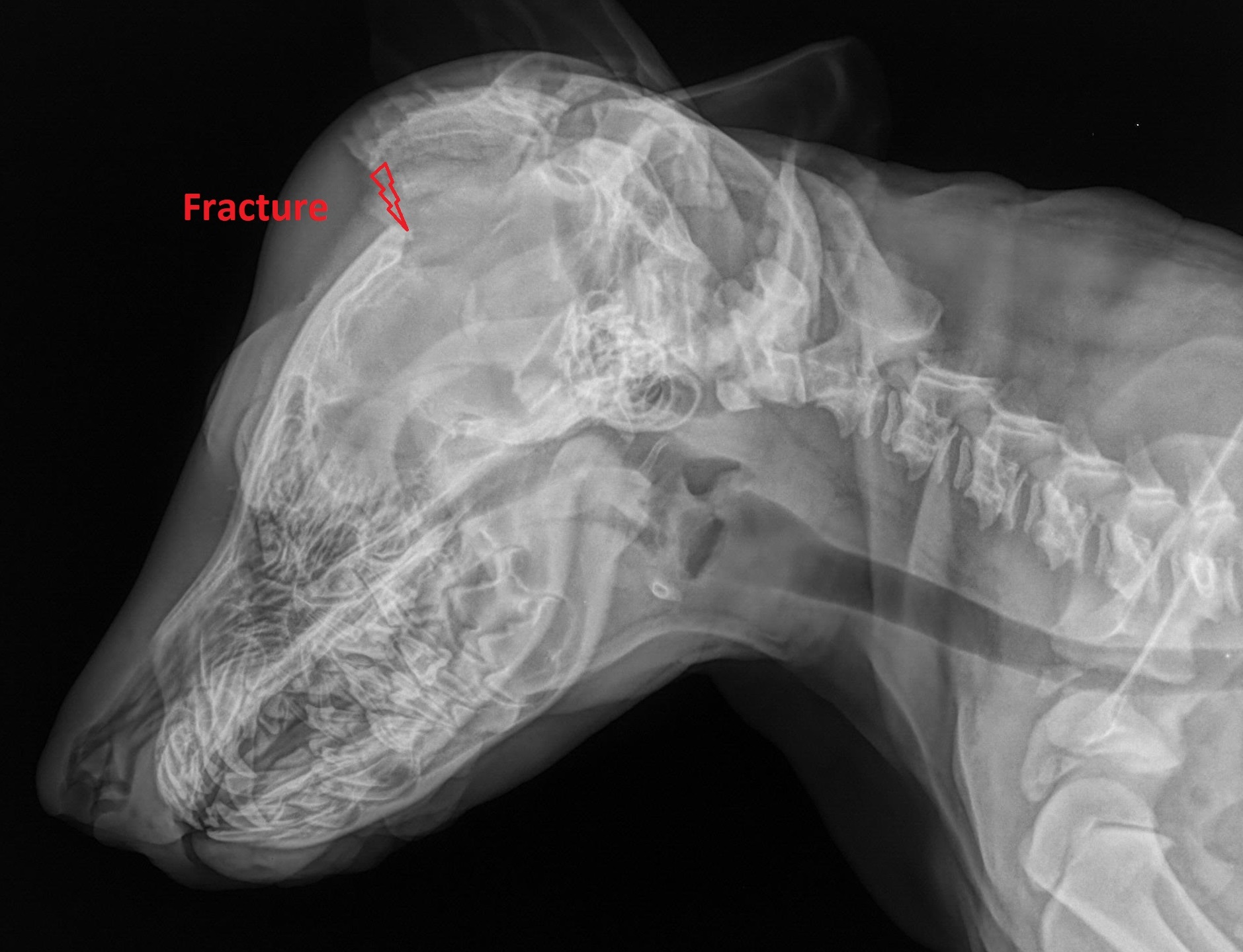 A fracture in the skull