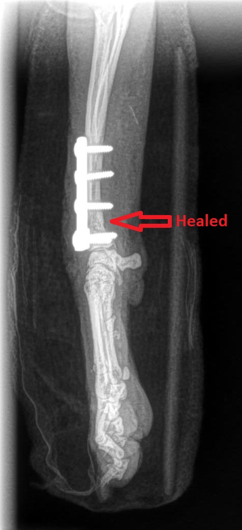 Screws and a plate holding the radius and ulna together