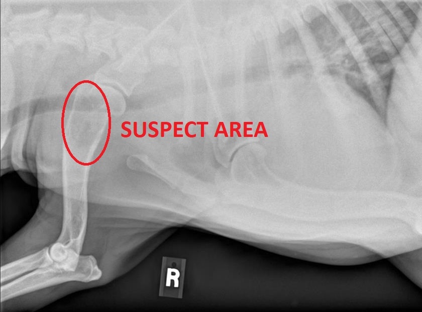 A cancerous mass in the bone