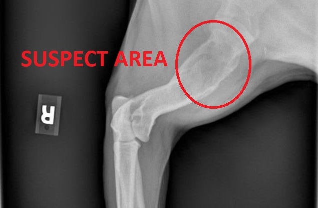 A cancerous mass in the bone