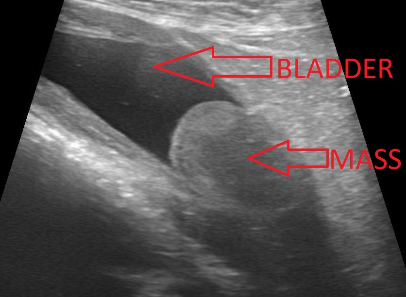 Ultrasound of the mass on the bladder