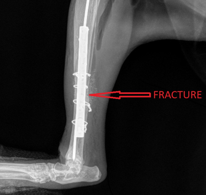 The repaired fracture