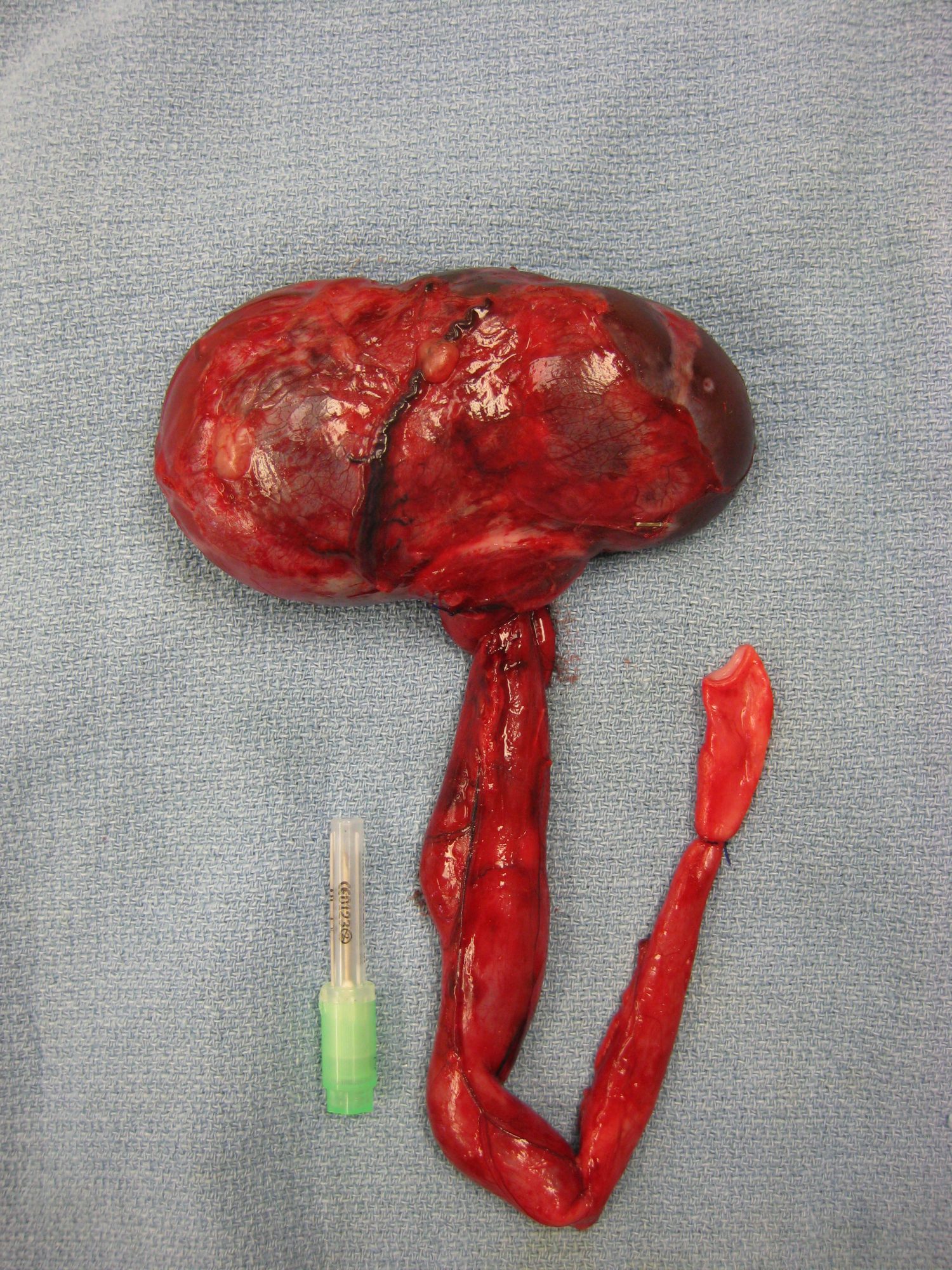 A removed kidney and ureter