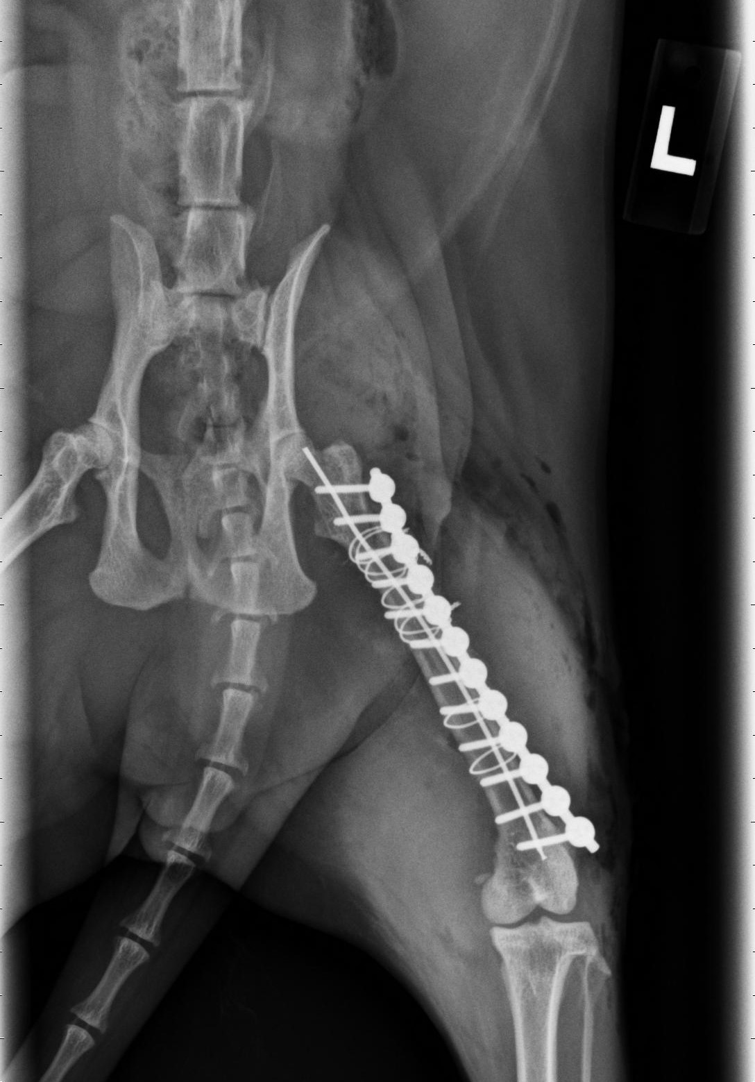 A broken limb repaired with pins and plates