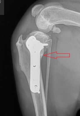 Complete healing of the bone 2 months after surgery